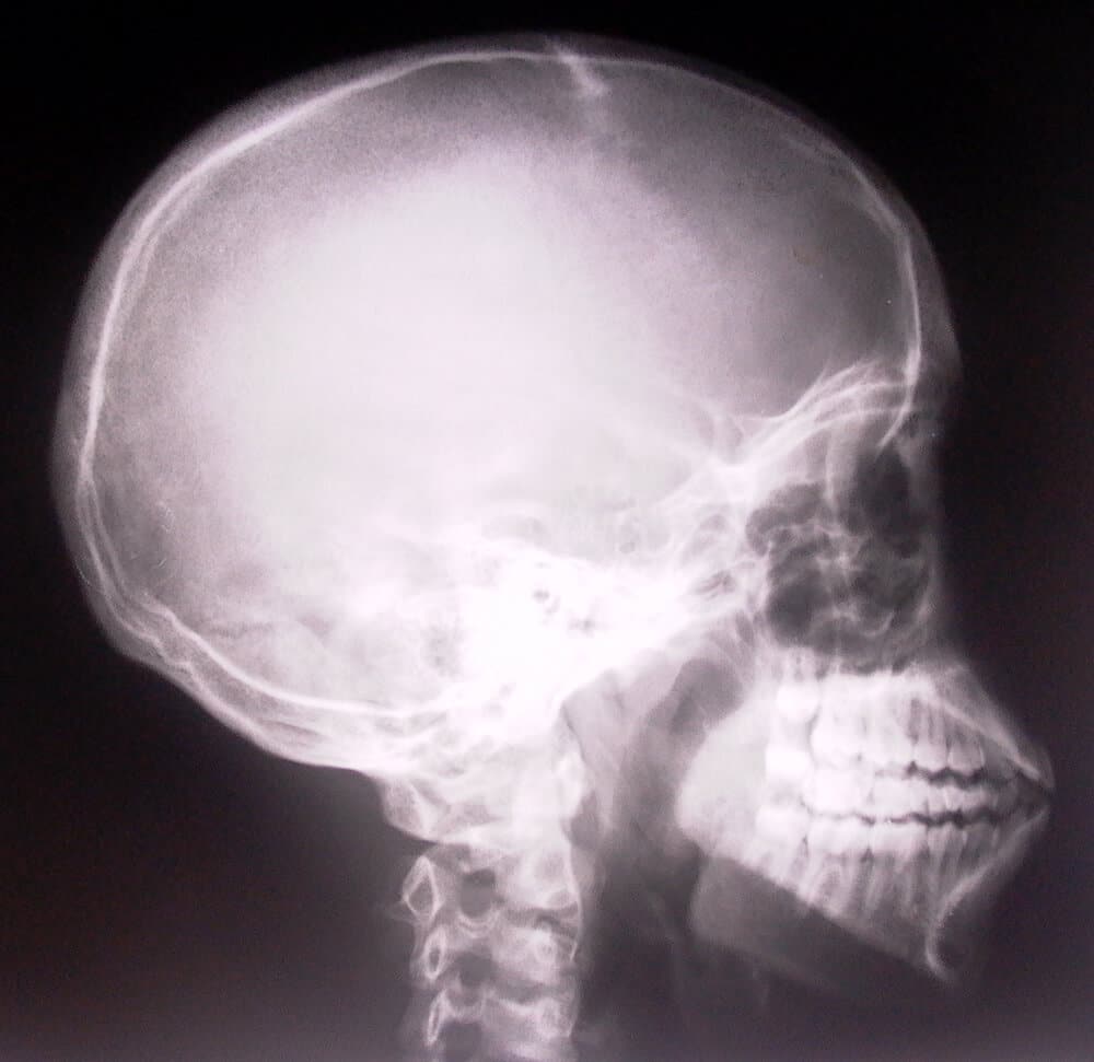 X ray of skull profile